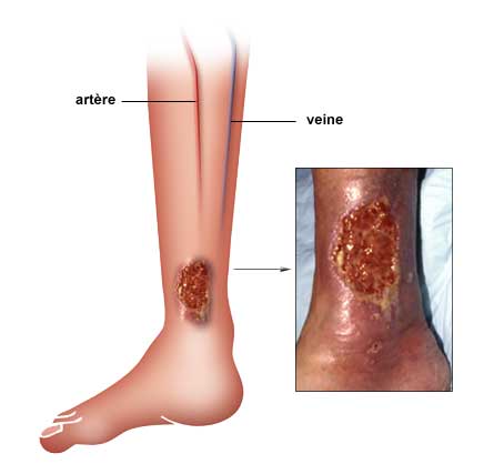 Thrombose a la jambe