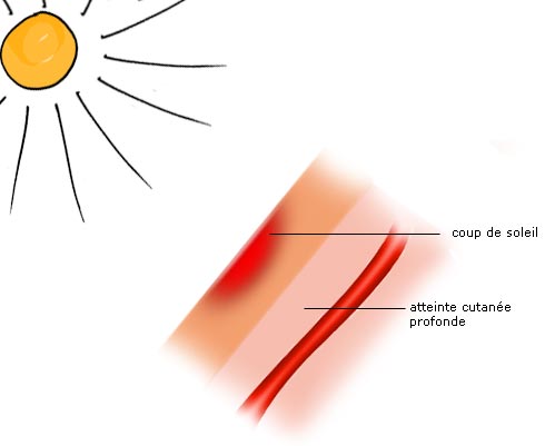 Biafine pommade pour brûlures - Creme coup de soleil et rougeurs, plaies