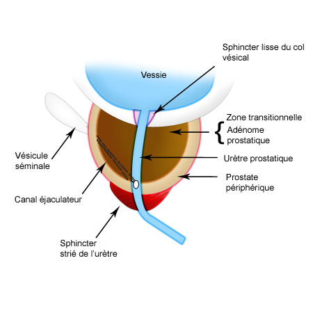 hypertrophie adénomateuse de la prostate centrale