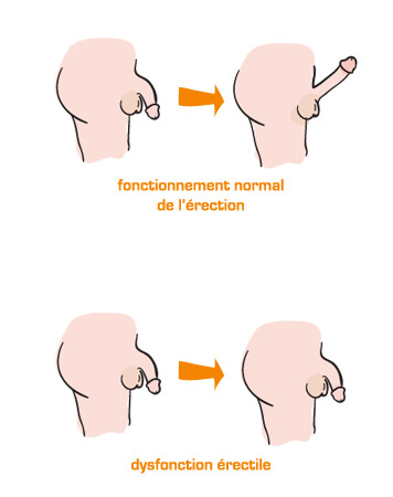 Trouble de l'érection : Que faut-il savoir sur les troubles de l'érection ?