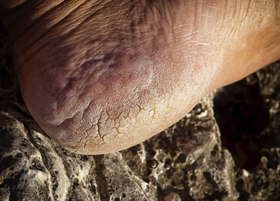 Creveasses / Engelures Crevasses et Engelures