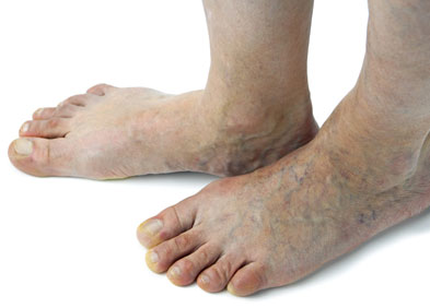 varicosités pieds