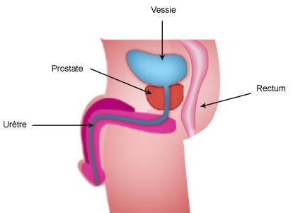 prostate adénomateuse)