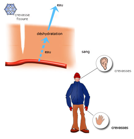 Crevasses et Engelures : Définition, symptômes, diagnostic et traitements