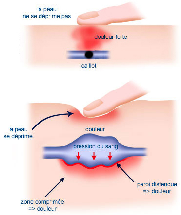 varice pelvienne et douleur jambe)