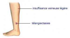 insuffisance veineuse légère