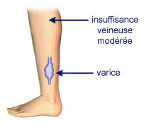 insuffisance veineuse modérée