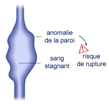 venele dulci i varice)