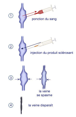 La sclérothérapie La sclérothérapie