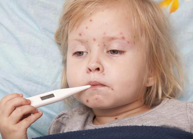 fièvre et varicelle