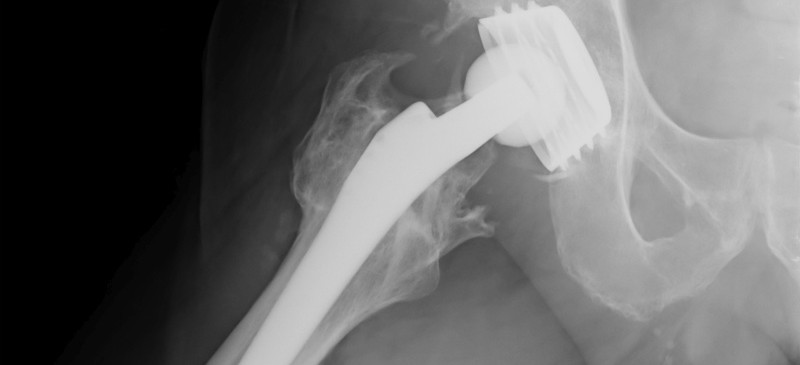 Le_quart_des seniors_meurent_apres_une_fracture_du_col_du_femur