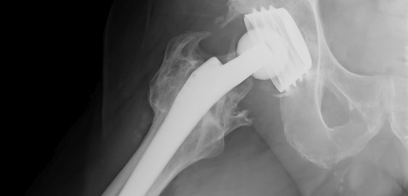 Le_quart_des seniors_meurent_apres_une_fracture_du_col_du_femur