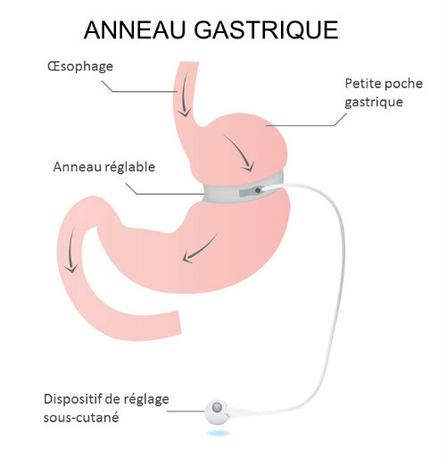 anneau gastrique