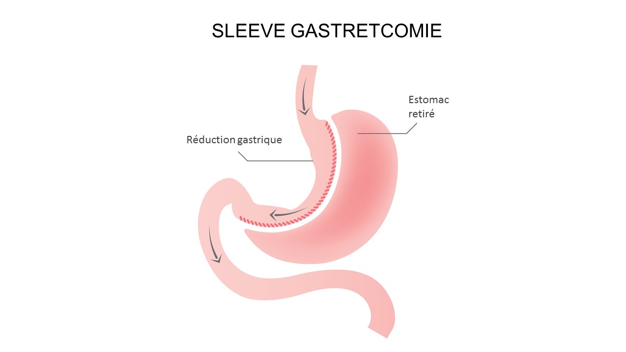 Pendant l'opération : chirurgie bariatrique et obésité
