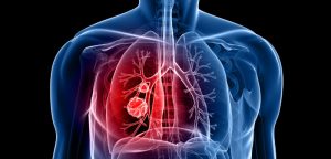 Un anticorps révolutionne le traitement du cancer du poumon