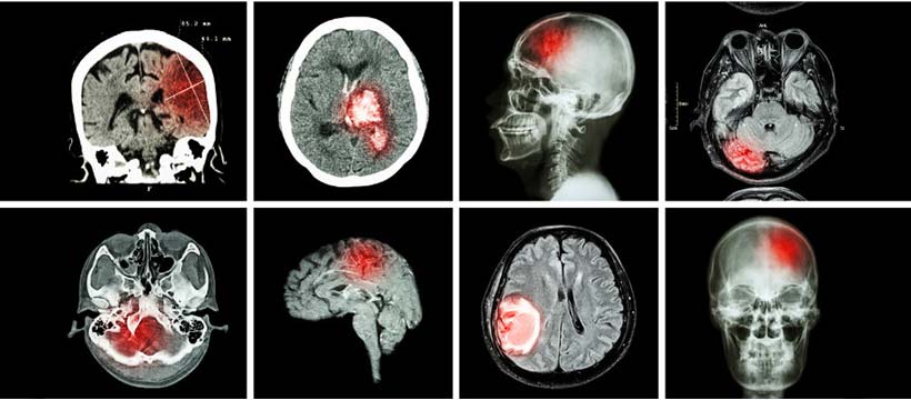 tumeur cerveau