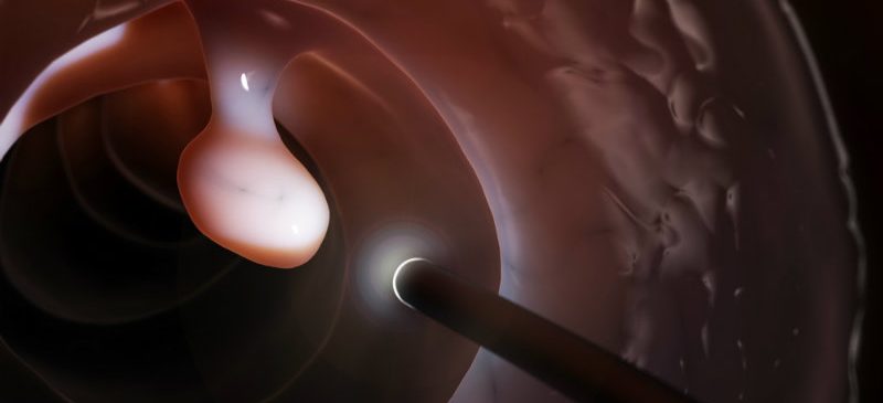 Dépistage cancer colorectal