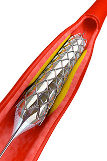 angioplastie