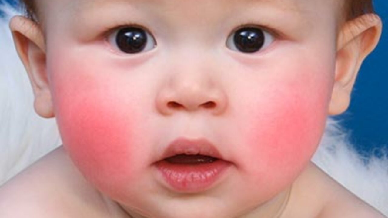 Erytheme Infectieux Megalerytheme Cinquieme Maladie Sante Sur Le Net