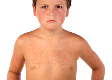 Scarlatine Maladies Infantiles Eruptives Sante Sur Le Net Scarlatine Maladies Infantiles Eruptives Sante Sur Le Net