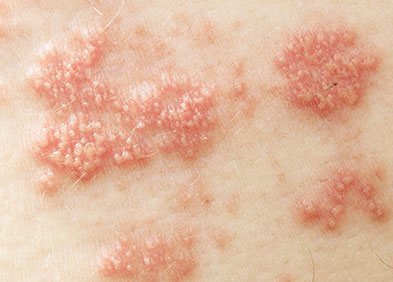 peau infecté par le zona