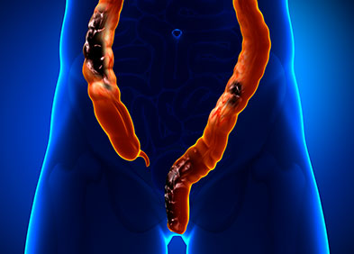 Douleur du colon Douleur du colon