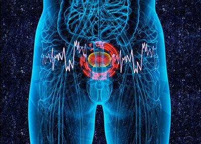 cancer maligne vessie)