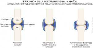 Polyarthrite rhumatoïde : définition, traitements - Santé sur le Net