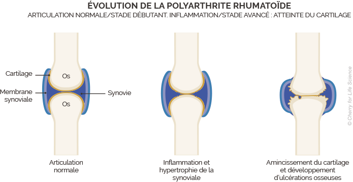 évolution de la polyarthrite rhumatoïde