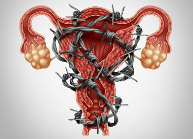 Endometriosis: síntomas, diagnóstico, tratamientos y riesgos de ...