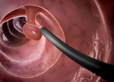 polyp suppression