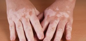 Vitiligo : L’intérêt de la photothérapie