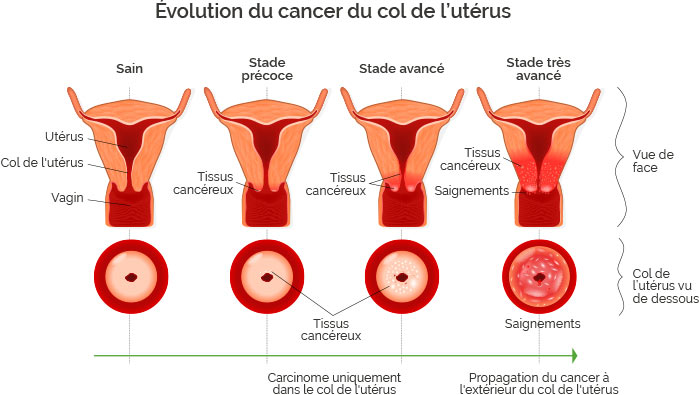 Symptome cancer uterus