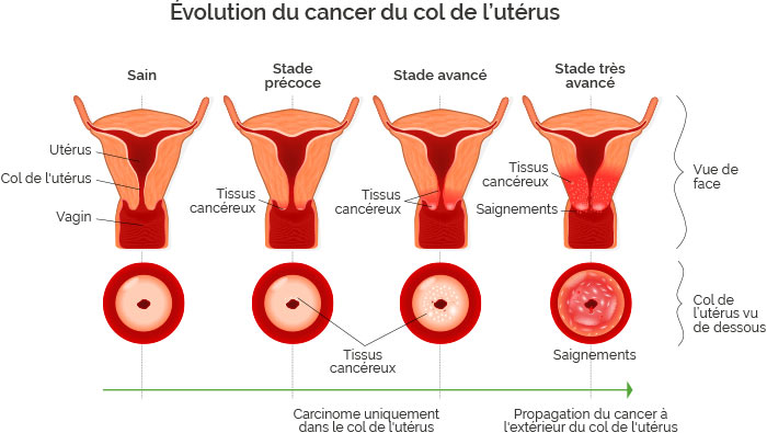 Evolution cancer_col de l'utérus