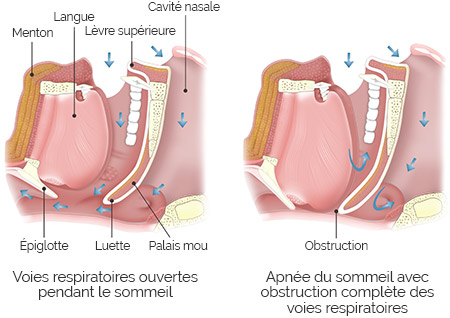 Projet SAHOS : l'apnée du sommeil chez l'enfant, vous connaissez ? - URPS  Médecins libéraux de Bretagne