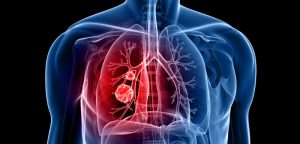 Cancer du poumon : un test sanguin pour optimiser le traitement