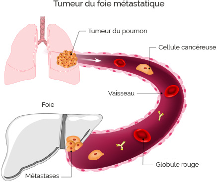 Anatomie du foie - Cancer du foie