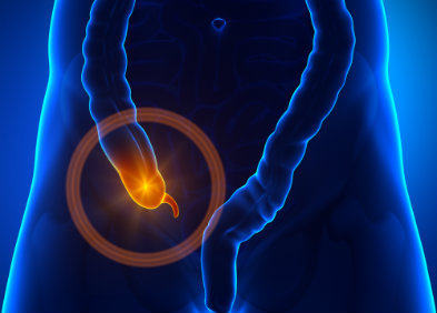 Appendicite aiguë: inflammation infectieuse de l'appendice