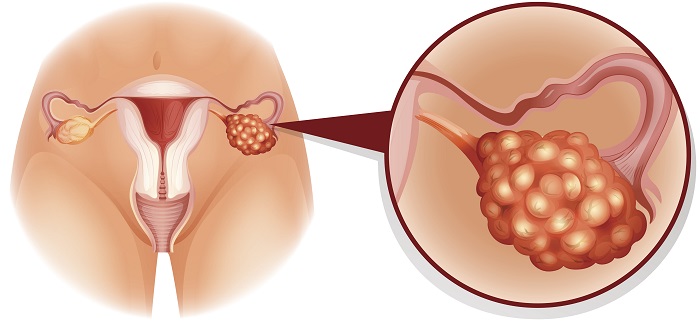 Cancer genital feminin symptome. Ductal papilloma icd 10