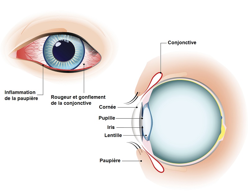 bacterie yeux human papillomavirus in sentence
