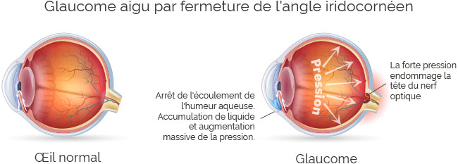 Glaucome Types Symptomes Diagnostic Suivi Traitements Glaucome Types Symptomes Diagnostic Suivi Traitements