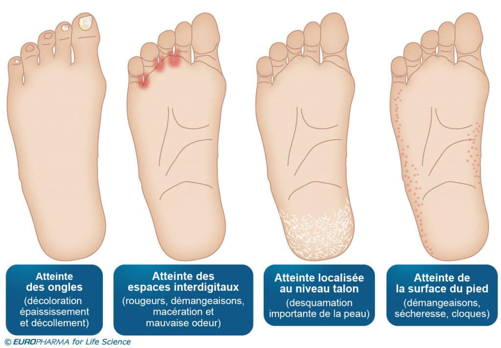 plante des pieds demangeaison plante des pieds demangeaison