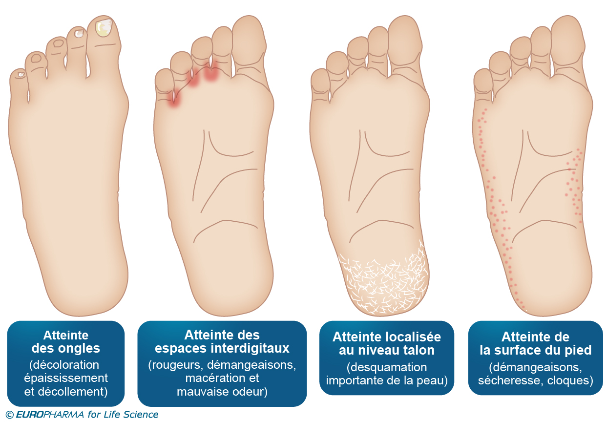 Mycose Des Pieds Symptomes Diagnostic Traitement