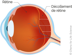 Décollement de rétine : causes, diagnostic, traitement