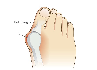 Oignon de pied ou Hallux valgus : définition et traitements