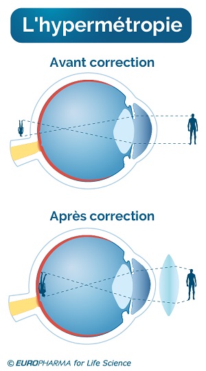 metoda de tratament hipermetropie raceala si ochi rosii