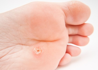 Papillomavirus verrue pied