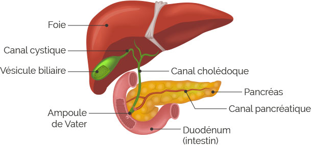 lithiase du choledoque