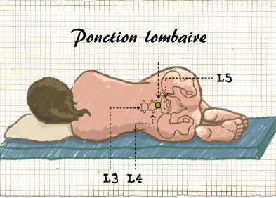 Ponction lombaire : définition et déroulement de l'examen