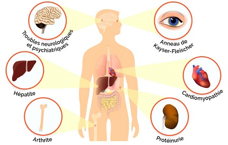 Maladie De Wilson Causes Symptomes Traitements Sante Sur Le Net